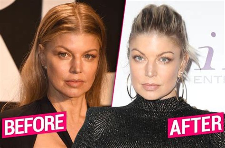 Fergie’s alleged “plastic surgery makeover” cost $30,000: was it worth it?