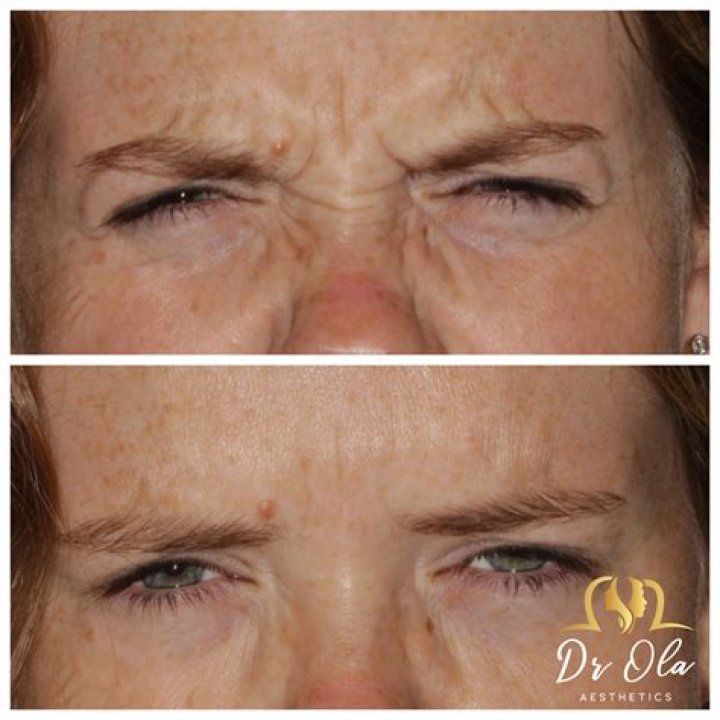 Heather Locklear’s new face: is she overdoing the Botox & fillers?