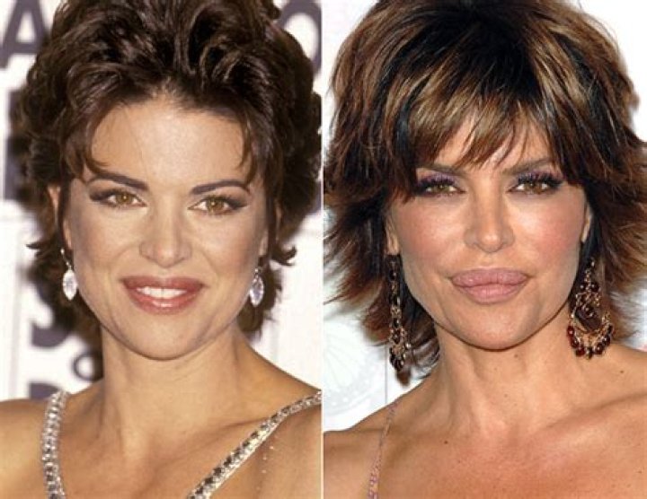 Lisa Rinna’s newly repaired duck lips aren’t healing properly