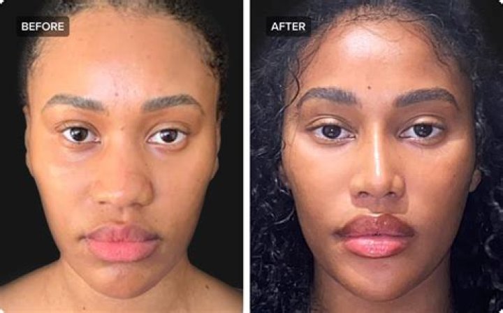 Sadie Mckenna Nose Job- Plastic Surgery Before And After Photos