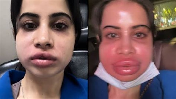 Urfi Javed Plastic Surgery, Before And After Lip Fillers Photo