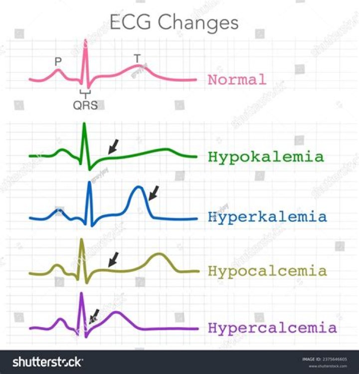 What are the ECG changes associated with pain in a patient with angina pectoris?